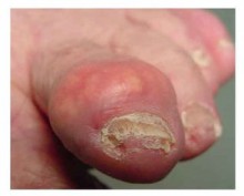 Questions and Answers about Gout - National Institute Of Health