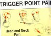 Trigger Points of Pain: Wall Charts (Set of 2) - Janet Travell, Janet Travell, David Simons
